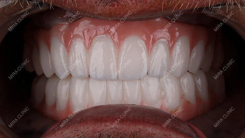 Full mouth dental crown treatment in Turkey